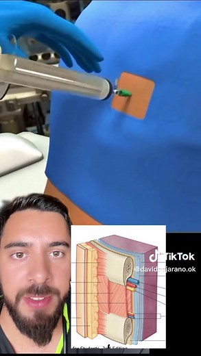 Procedimiento de Toracocentesis: Extracción de Líquido Pleural de Forma Guiada