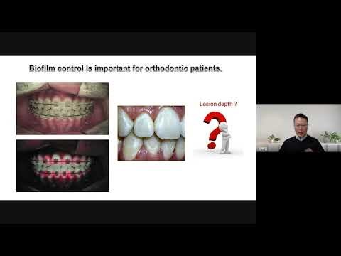 [AIOBIO] QBLISS Clinical Series | Episode 3 – Early Tooth Decay Detection With QBLISS/QLF