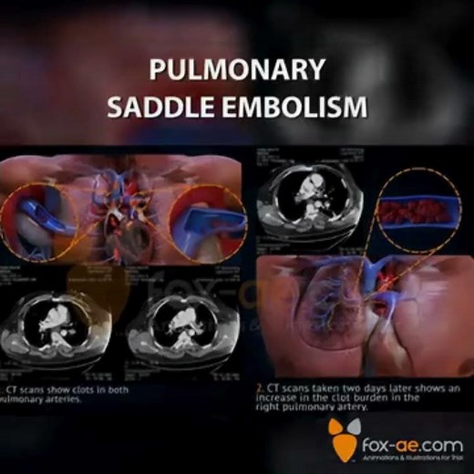 Pulmonary Saddle Embolism