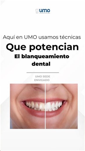 Técnicas que potencian el Blanqueamiento #Dental