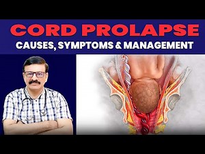 Cord Prolapse | Causes, Symptoms & Management