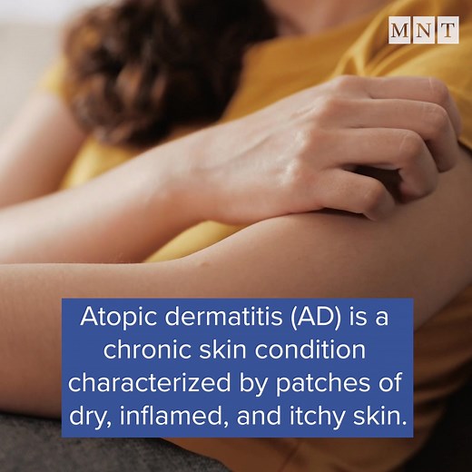 Explore important facts about atopic dermatitis, a type of eczema, with expert advice and practical information for daily management. | Medical News Today | Facebook