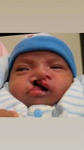Hi 👋🏼 everyone! Watch the following Reel 🎥 cataloging this #cleftcutie’s progress over the last SIXTEEN years following his RIGHT COMPLETE cleft lip and palate reconstruction. Where does time 🕰️ go?! 🤷🏻‍♀️ It is so very important for parents to see and understand the many changes that occur to the lip, nose and scar during the months and years following their child’s cleft repair. The lip is often pink and firm for months after the surgery. The scar may also contract, causing shortening of