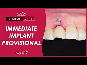 Maxillary anterior immediate placement [Dr. Kim Jaeyoon]