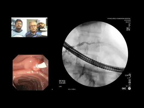 3- ERCP with Pancreatic Endotherapy by Dr. Amit Maydeo