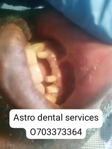 fixing permanent teeth ( dental bridge).