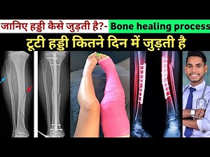 How does a bone join – how many days does a fracture take to heal, how does a broken bone join, b...