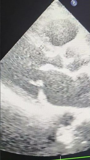 RHD: Myxomatous degeneration: Silent Heart Killer | Findings on 2DEcho! #RheumaticHeartDisease