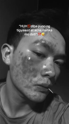 #acne #azelane #azelanesoap