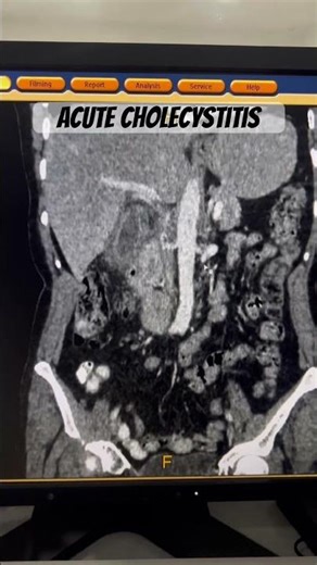 What Is Acute Cholecystitis? CT Scan Findings #shorts