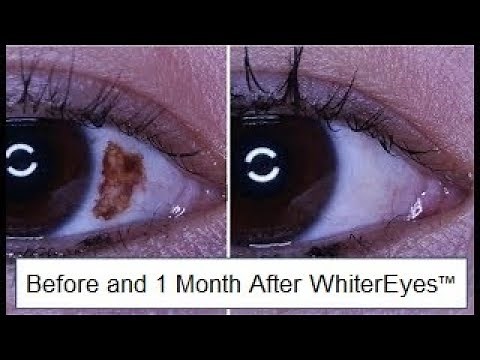 Eye Freckle/ Pigment Treatment with WhiterEyes® Eye Whitening
