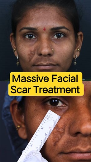 Massive Facial Scar Transformed with Serial Excision | Real Scar Revision Results! | Dr DC, Pune