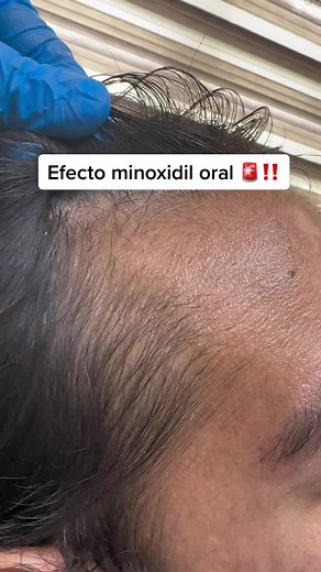 Efecto del Minoxidil Oral para Recuperación Capilar