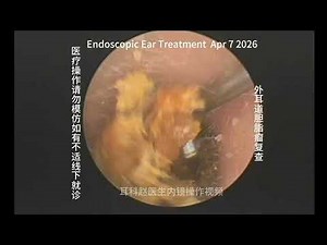 examination and debridement of a middle ear cholesteatoma and routine earwax removal 20260407