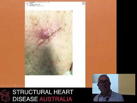 Pacemaker lead extraction Dr Peter Brady