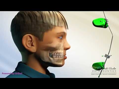 Reverse Pull Headgear