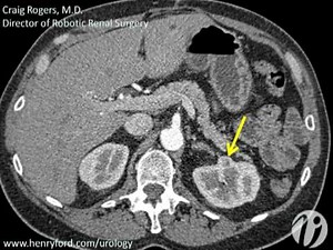 Robotic Partial Nephrectomy - Step 1: Patient Information and Operative Setup • Video • MEDtube.net