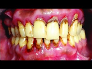 Periodontitis Explained | Chapter 4 – Stages & Progression of Gum Disease