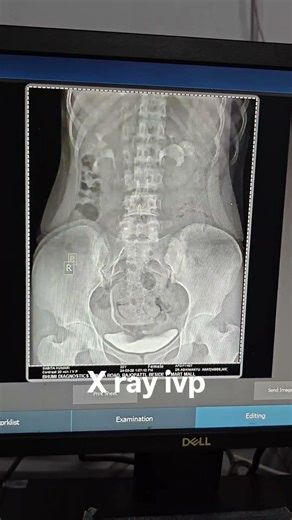 @x ray ivp