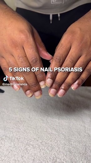 Nail psoriasis ain’t fun and is not easy at all but there are ways to manage it. #psoriasis #psoriasisawareness #psoriasiswarrior #nailpsoriasis #nails #psoriasistok #livingwithpsoriasis #nailfungus #fungus