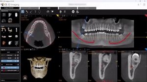 Step into the future of dental imaging with the new version of CS 3D Imaging software!  Our latest update introduces AI-assisted automatic mandibular nerve mapping, with one click. Elevate your diagnostics and treatment planning effortlessly.  Learn more about the CS 3D Imaging’s new features here: https://ow.ly/IcS350RA2XC #CS3DImaging #artificialintelligence #digitaldentistry #carestreamdental #dentistrysoftware | Carestream Dental | Facebook
