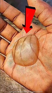 Never Pop a Foot Blister! ⚠️ Here’s Why