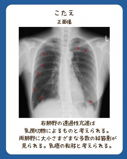 胸部レントゲン 一問一答 #3