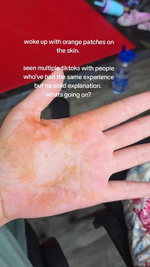 Understanding Skin Discoloration: Causes and Solutions