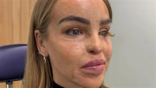 Katie Piper's emotional update after eye surgery as she ‘reaches end of road’