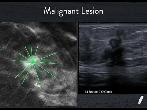 Breast Ultrasound Part 1