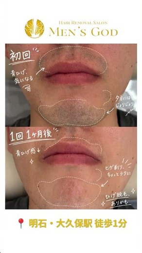 【ヒゲ脱毛1回】1ヶ月後のビフォーアフター｜明石 MEN'S GOD #ヒゲ脱毛