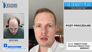 5 Months FUE Hair Transplant Review By Client From Norway. Procedure Done By Dr. Zulfiqar H. Tunio at Tunio Aesthetics Dubai. (Part 2) Book Free Consultation: https://www.tuniohairtransplant.com/make-an-appointment Call / Whats App: +971 551334093 #HairTransplant #FUEHairTransplant #HairTransplantResults #HairTransplantReview #HairLossTreatment | Tunio Aesthetics | Facebook
