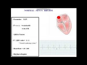 Normal Sinus Rhythm ( NSR )