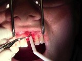 Pouch Technique, II - Extraction #9 with GBR-Socket Grafting • Video • MEDtube.net