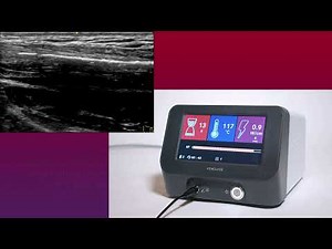 Procedure Video featuring the Venclose™ RF Ablation Catheter