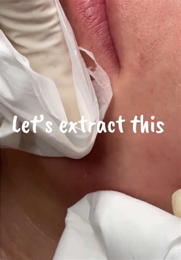 Extraction Techniques for Blackheads and Whiteheads
