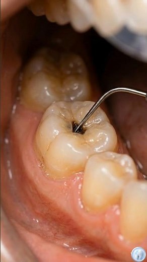 Tiny Black Spot? Watch This Cavity Get Fixed Instantly 😳