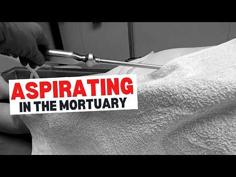 Using the trocar to aspirate the deceased