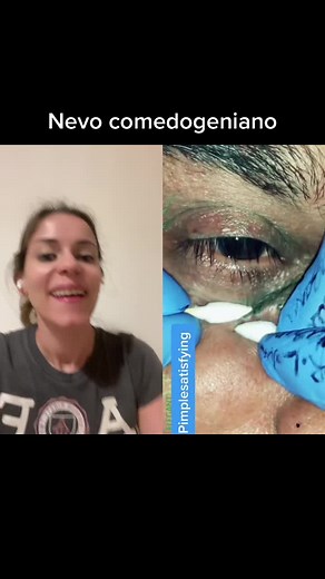 Consejos sobre Comedones y Nevo Comedogeniano