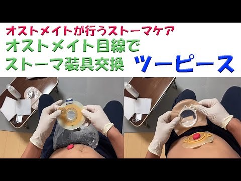 【オストメイトの生活関連】オストメイト目線でストーマ装具交換（ツーピース）