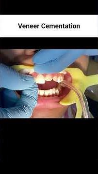 Emax Veneer | Step-by-Step Smile Makeover | Dental Fluorosis Treatment | Dr Vijay Kumar