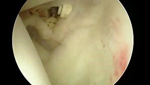 Arthroscopic ACJ reconstruction using a Rope Device