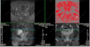 MRI of the prostate gland, revealing an enlarged size, aids in diagnosing tumors, guiding treatment decisions, and monitoring prostate health.