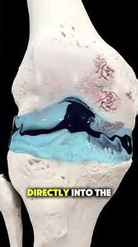 How VISCOS Injection Is Injected for Knee Pain | Step-by-Step explained #ViscosInjection #kneepain