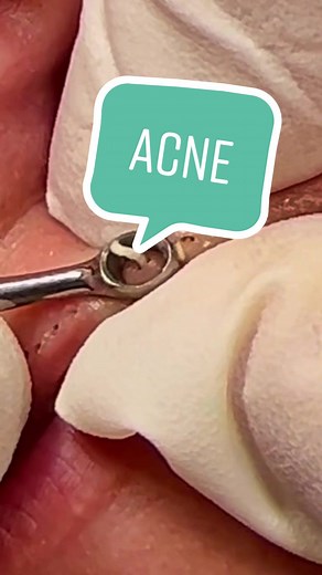 Small cysts around the lips!#cyst #pimple #pimplepop #cyst #tiktok #cystpopping #foypage #foy #sebum #foryou #acnetreatment #acne #acnetiktok #lips #face #crete #greece