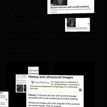 Fournier’s gangrene (necrotizing fasciitis of the perineum)