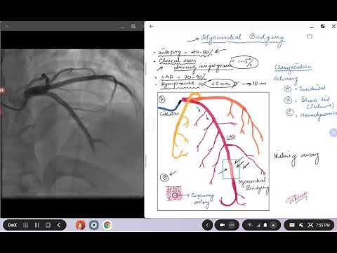 Coronary Angiogram. Myocardial Bridging.