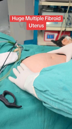 Laparoscopic Surgery for Huge Uterine Fibroids