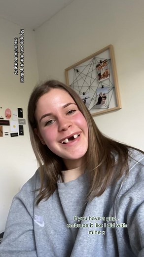 Palatal Expansion Surgery for Tooth Gap: Embracing Differences