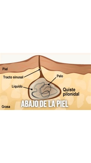 Dr Jorge Alberto Riancho Guzmán on Instagram: "¿Cómo se forma realmente un quiste pilonidal? Explicación con dibujo El quiste pilonidal (también llamado sinus pilonidal) NO es un quiste verdadero desde el nacimiento, sino una condición adquirida que se desarrolla por la interacción de pelos, fricción y la anatomía de la zona. #mexico #quistepilonidal #jorgealbertoriancho #cirugiageneral #quistes"